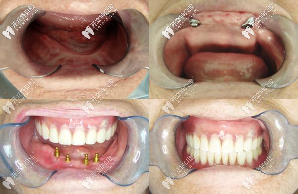 咸陽海濤口腔ALL-on-4全口種植