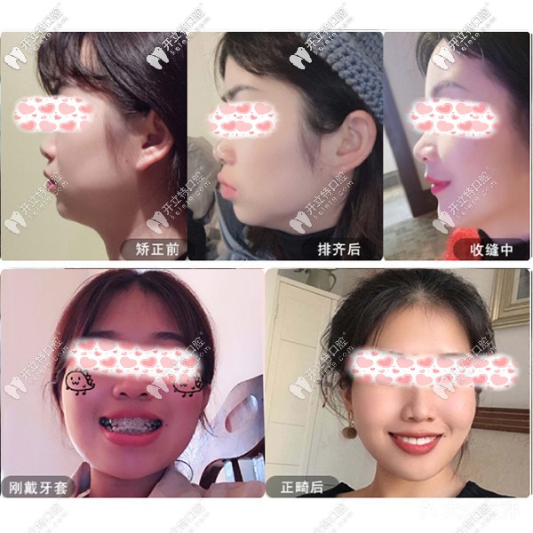 重慶樂樂欣口腔的盤龍店正畸收費價格表搶鮮一覽