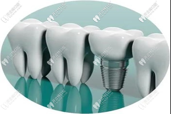 烏魯木齊市進(jìn)口種植牙多少錢