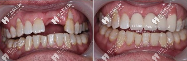 咸陽海濤口腔多顆種植牙