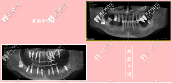 陳先生術(shù)前術(shù)后全景對比圖