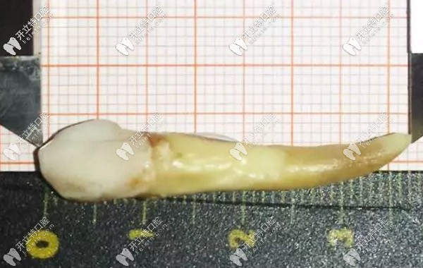 人的智齒較長(zhǎng)有幾厘米，3.72厘米的牙齒你見過嗎？