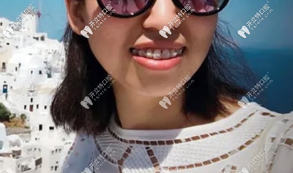 關(guān)于牙套臉的問(wèn)題我來(lái)說(shuō)說(shuō)自己的看法