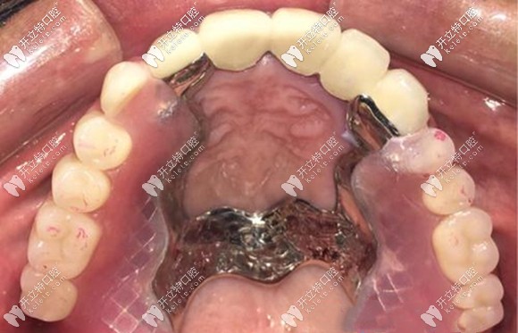 套筒冠和精密附件為什么很少有人做了,是效果不佳嗎？