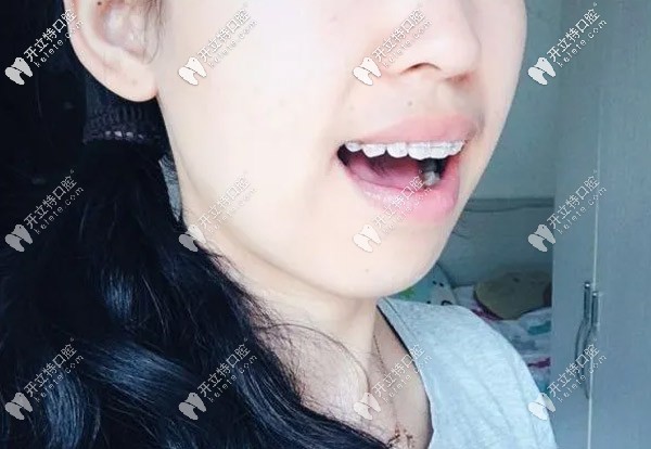 剛出醫(yī)院門口托槽就掉了