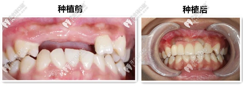 19歲妞門牙缺失4個(gè),來(lái)吐槽“鄭州唯美口腔”的種植牙技術(shù)