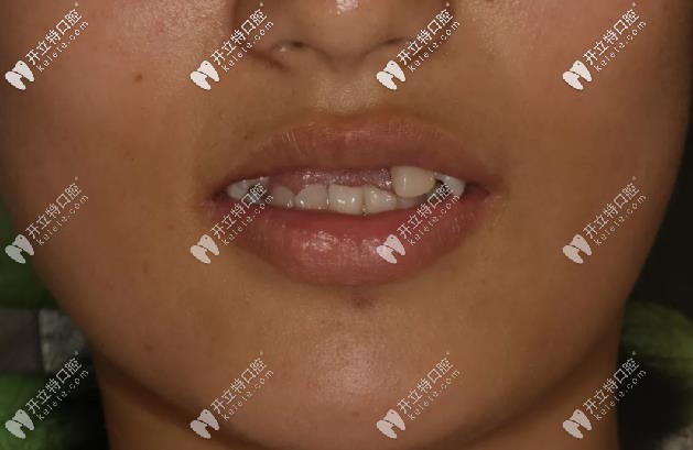 19歲<!--<i data=20240703-sp></i>-->生-摔斷4顆門牙、缺牙四年