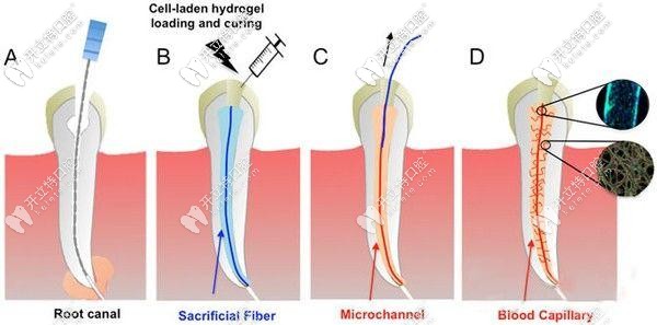 一個(gè)牙根做根管會(huì)便宜一些