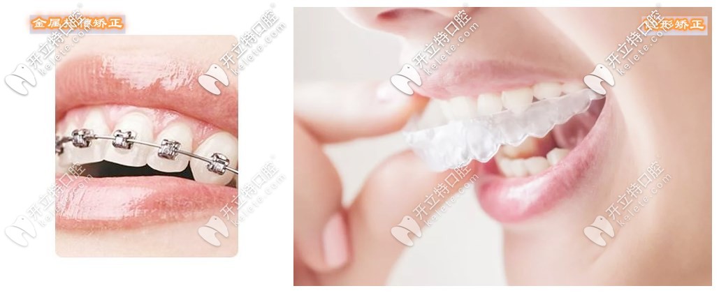 金屬牙套和隱形牙套