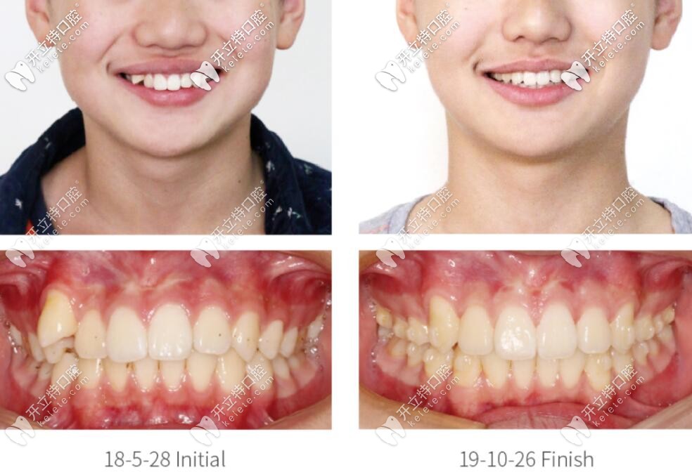 達(dá)芬奇雙膜牙套矯正深覆合的案例