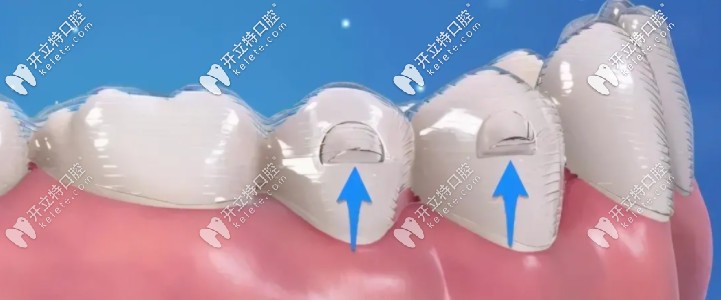 牙齒矯正器上的附件：“小凸點(diǎn)”竟是隱形牙套里的扛把子