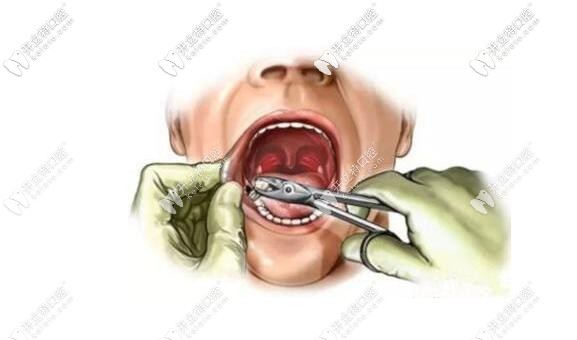 微創(chuàng)拔牙步驟 微創(chuàng)拔牙步驟