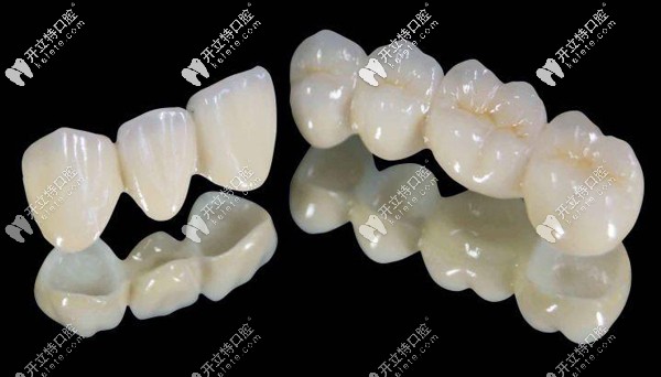 樂瓷全瓷牙價格是多少，怎么辨別德國樂瓷牙冠真假呢？