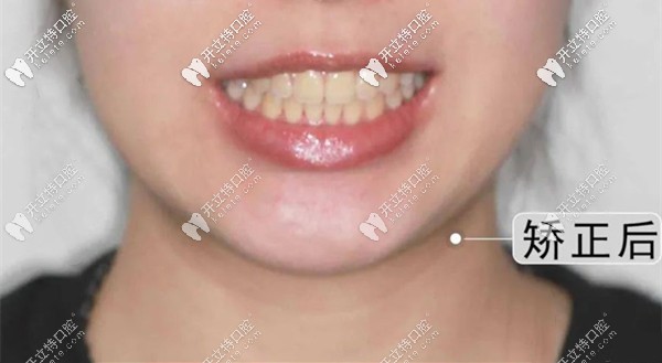 在晉中紅十字口腔做完矯正后的效果圖