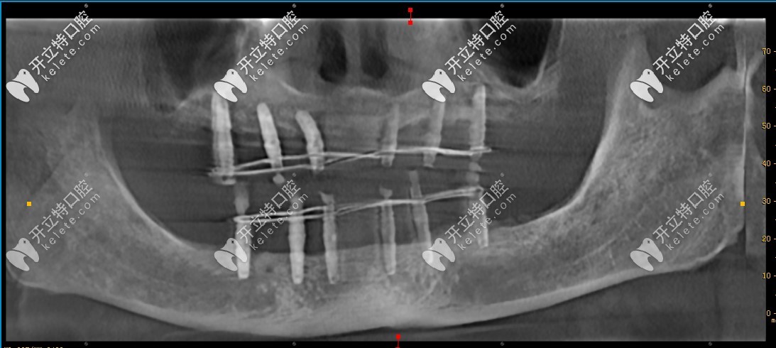 植入種植體后的ct圖