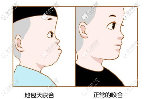 牙齒地包天有必要治嗎？哪個(gè)年齡階段矯正比較好