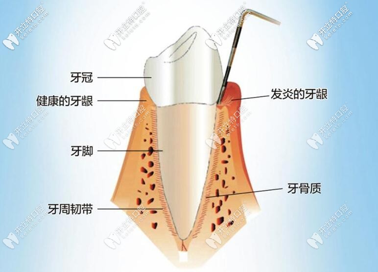 牙周炎癥 牙周炎癥