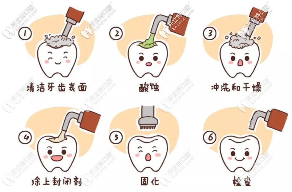 窩溝封閉治療 窩溝封閉治療