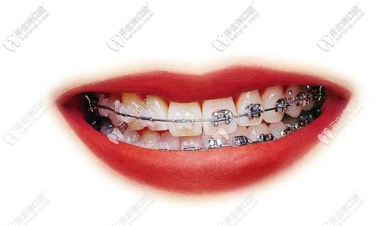 牙齒正畸 牙齒正畸
