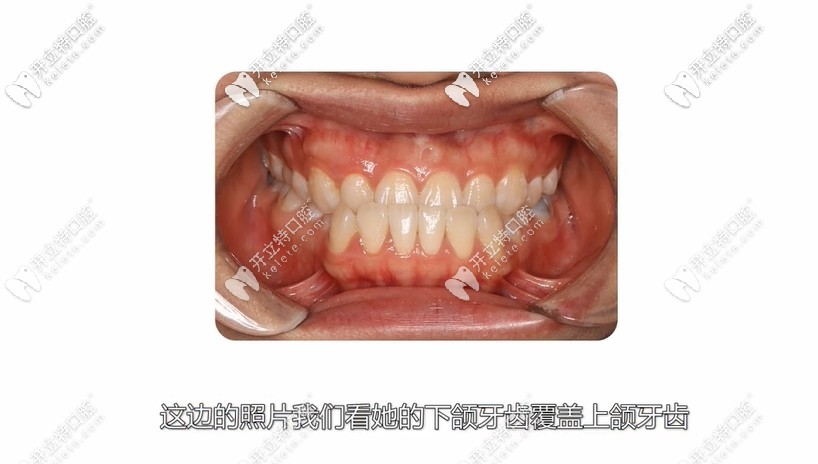 反頜地包天案例