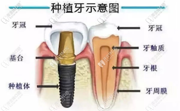牙齒種植示意圖