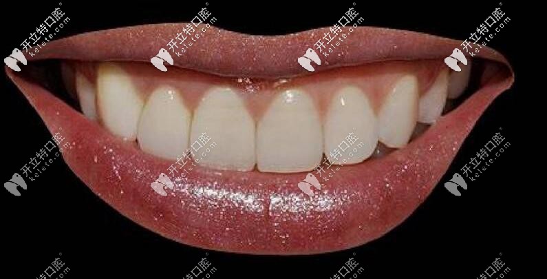 前牙美學(xué) 前牙美學(xué)