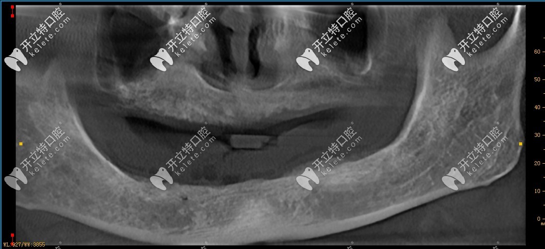 種牙前的牙槽骨