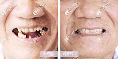 種牙前后對(duì)比