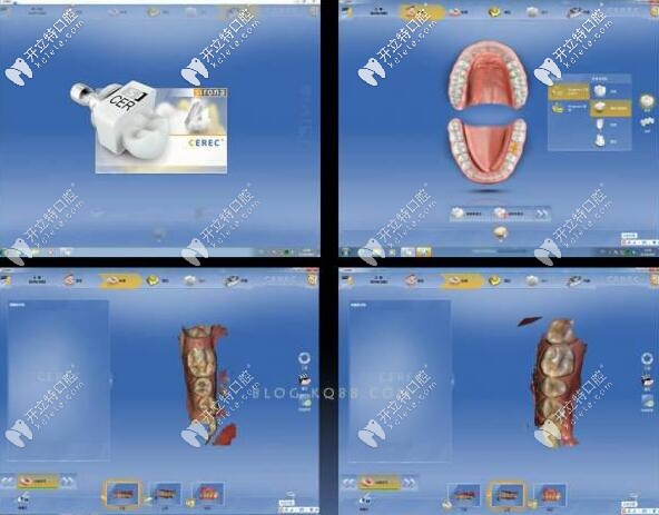 CAD/CAM設(shè)計(jì) CAD/CAM設(shè)計(jì)