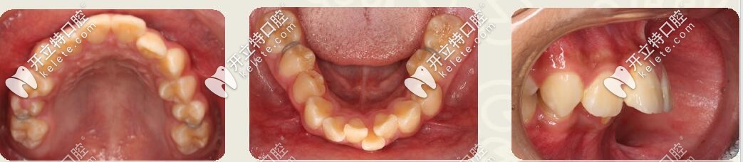 深復蓋凸嘴伴下巴后縮,直絲弓聯(lián)合擴弓,斜導矯正27個月對比