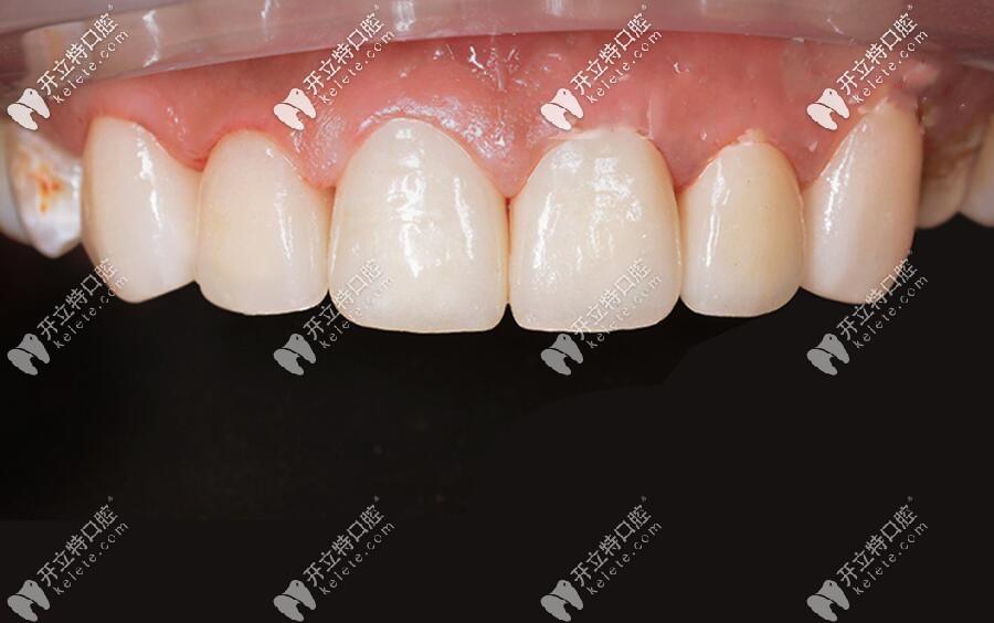 門(mén)牙做全瓷牙效果圖
