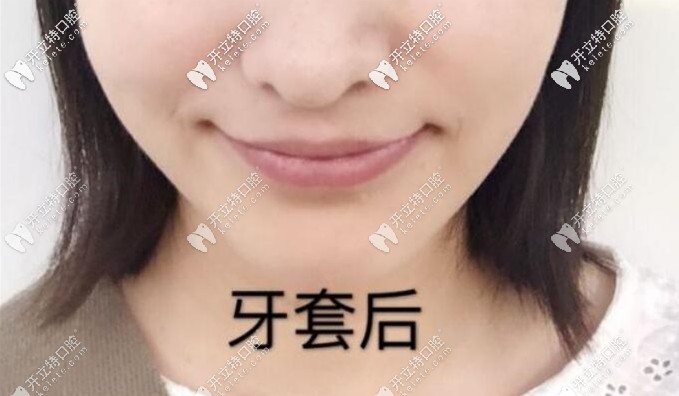 內(nèi)傾型三度深覆合矯正后效果圖