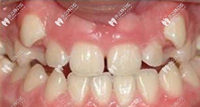 說我是齙牙妹一點(diǎn)都不為過吧