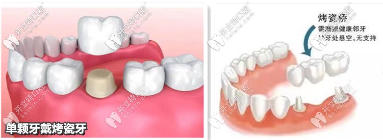 單顆、3連冠烤瓷牙—示意圖
