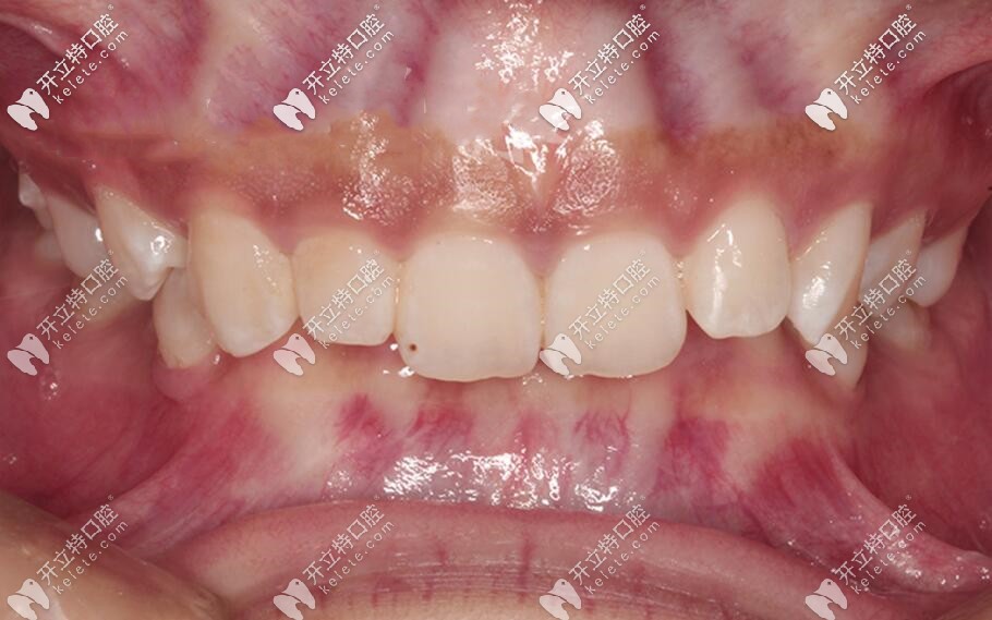 三度深覆合照片