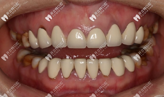 在小診所做的全瓷牙，死白，沒(méi)有一點(diǎn)美感可言