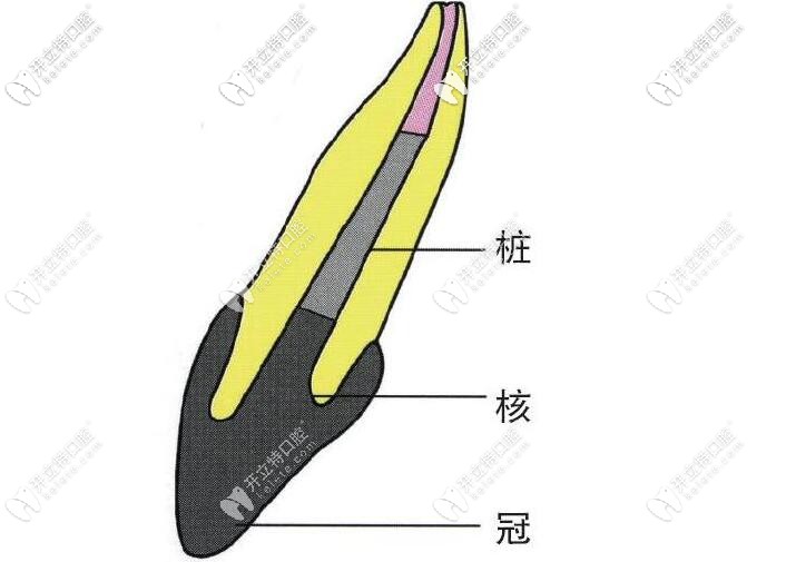 樁核冠修復(fù)
