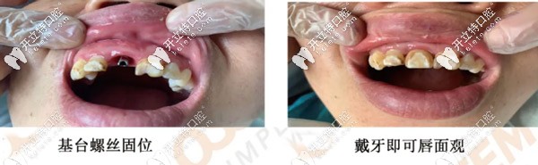 修復后與原牙色澤想同