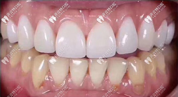 全瓷貼面和樹脂貼面的區(qū)別~拆過2次貼面全瓷貼面抗污性強