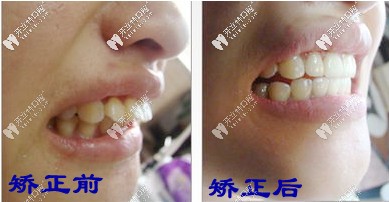 矯正前后對(duì)比