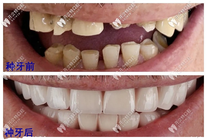 種牙前后對比