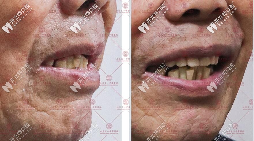 60歲大爺?shù)姆N牙種牙案例