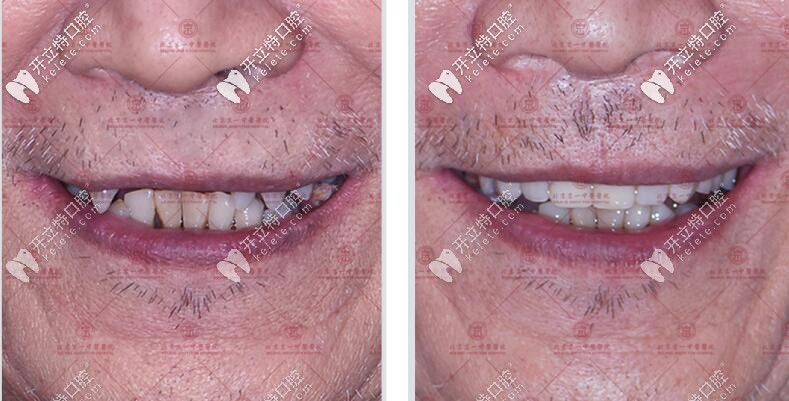 種4顆半口種植牙的效果對比