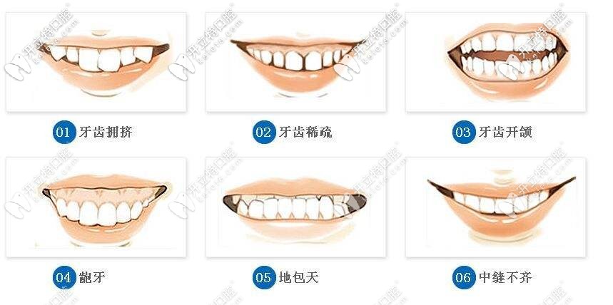 牙齒矯正的適應(yīng)癥狀