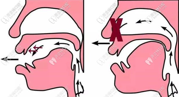 重度下頜后縮導(dǎo)致氣道狹窄示意圖