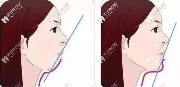 小孩子下巴后縮,通過正畸導(dǎo)下頜向前的較佳年齡是幾歲？