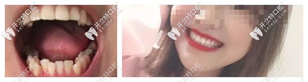 揭陽(yáng)華美口腔真人案例