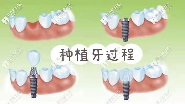 韓國(guó)紐百特和登騰的使用壽命