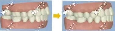 無托槽隱形矯治磨牙后推
