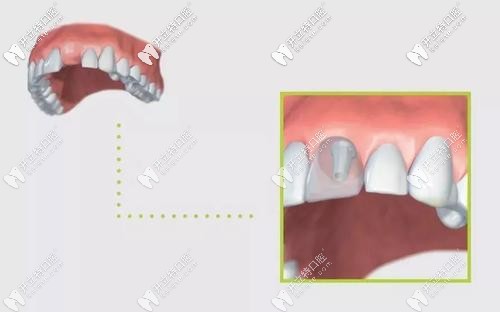 可以避免牙周被破壞的種植牙新技術(shù)“盾構(gòu)術(shù)”了解一下？